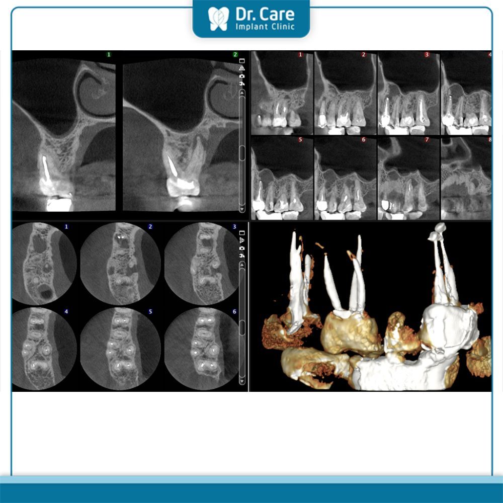 Ứng dụng của CBCT trong điều trị nha khoa