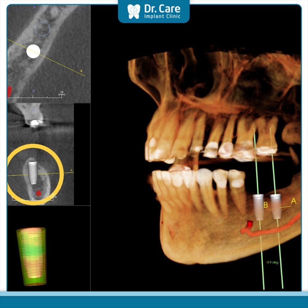 Chụp phim Cone Beam CT là gì?