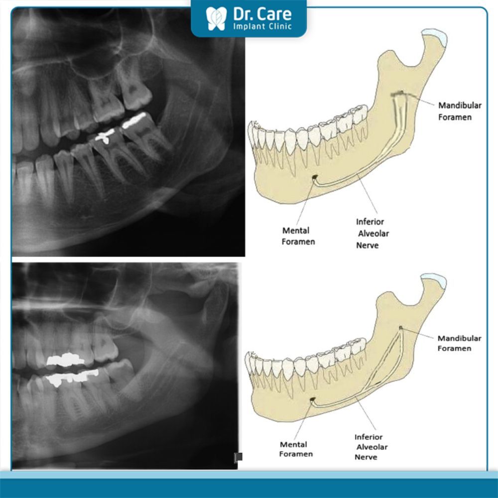 Ứng dụng của CBCT trong điều trị nha khoa