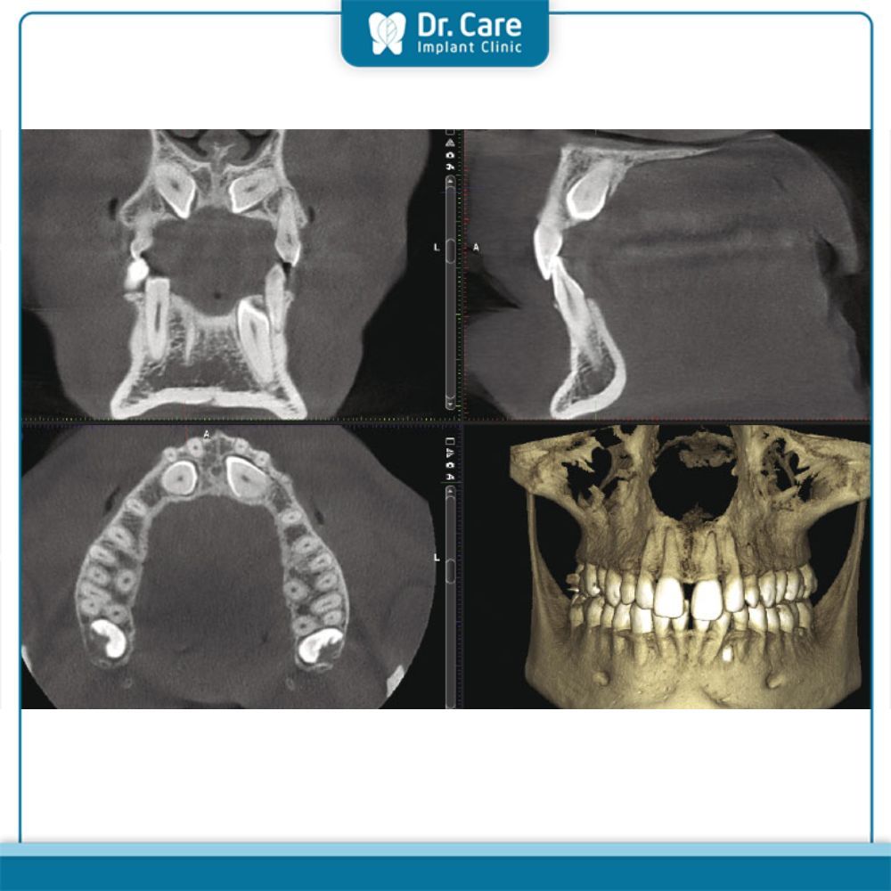 Ứng dụng của CBCT trong điều trị nha khoa