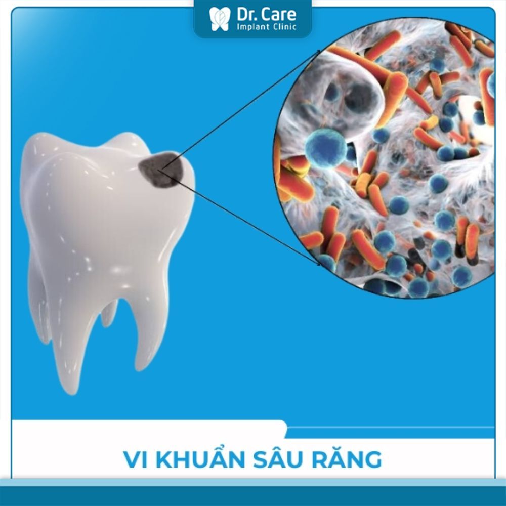 Vi khuẩn nào trong miệng gây hại đến sức khỏe?