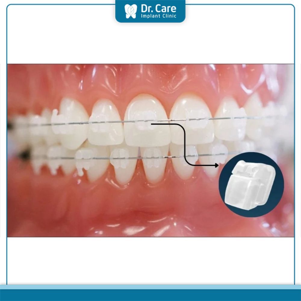 Đối tượng nào thích hợp niềng răng mắc cài pha lê?