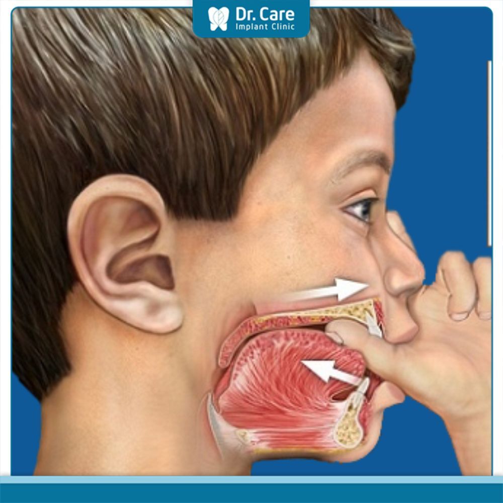 Nguyên nhân mặt lưỡi cày