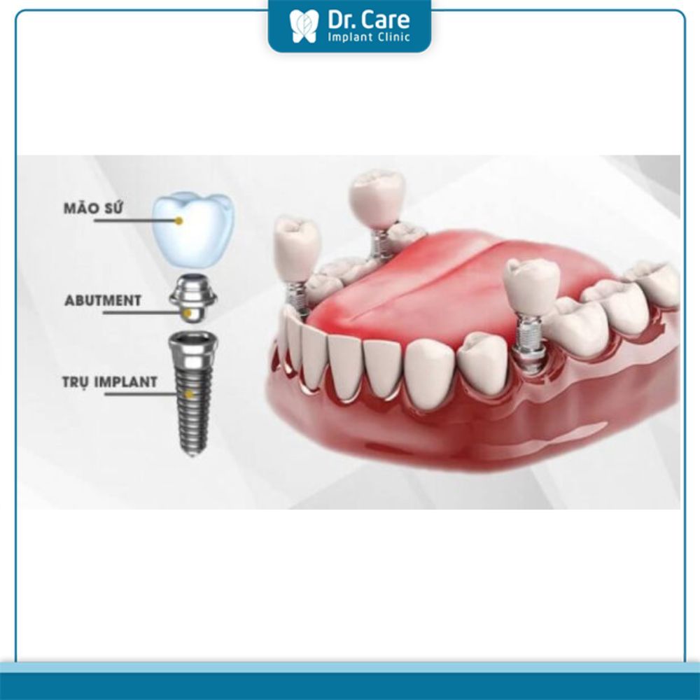 Hoại tử tủy răng có trồng răng Implant được không?