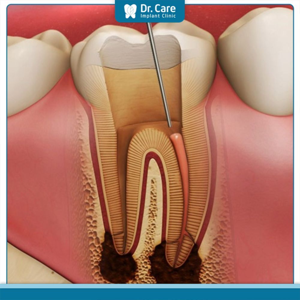 Các triệu chứng lâm sàng nào thường được quan sát thấy ở bệnh nhân bị tủy răng hoại tử theo các giai đoạn?
