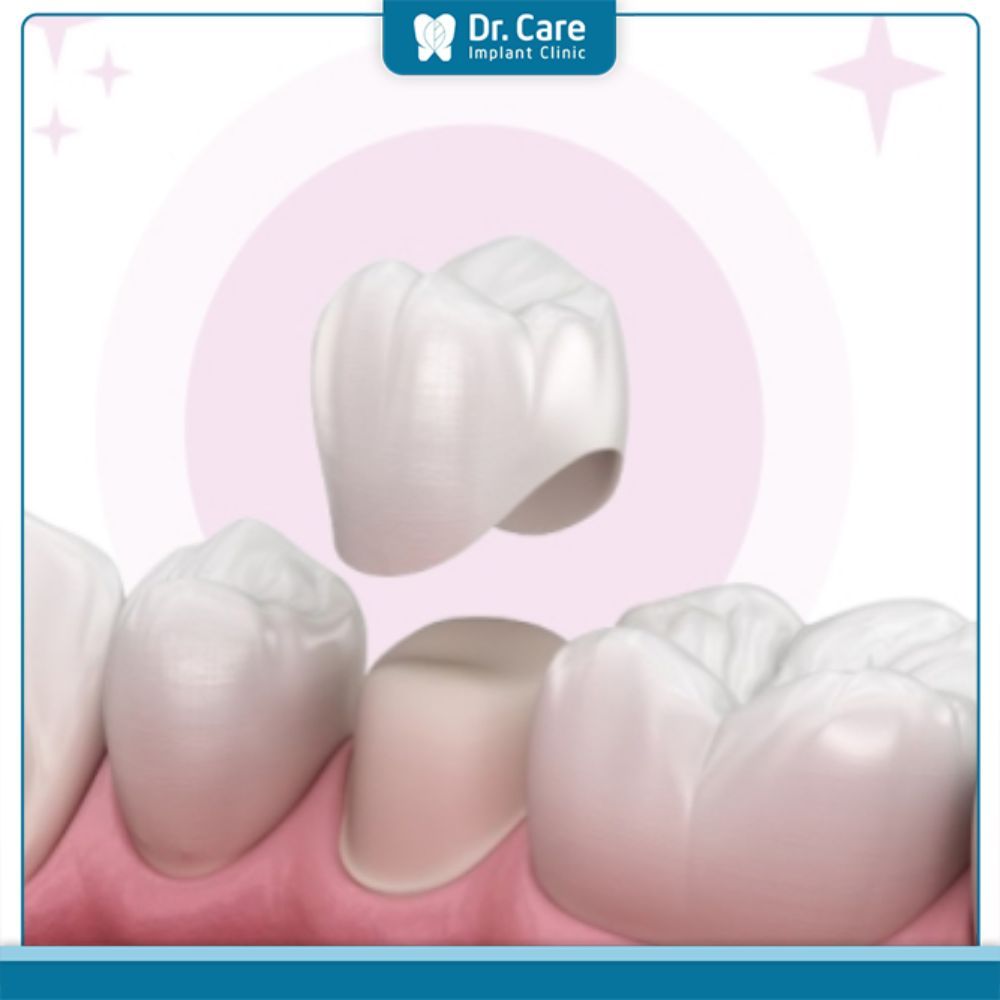 Giải pháp khắc phục tình trạng vết trám răng bị đen