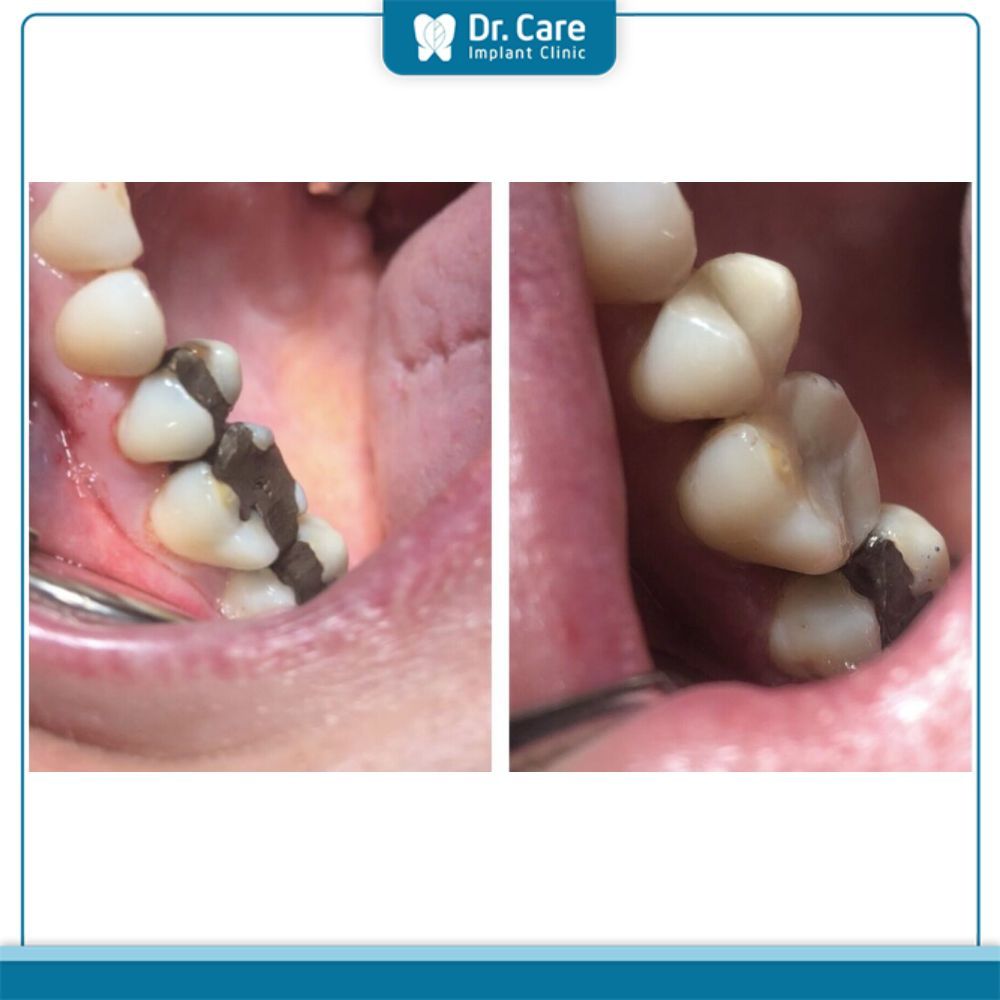 Ảnh hưởng của miếng trám răng bị đen