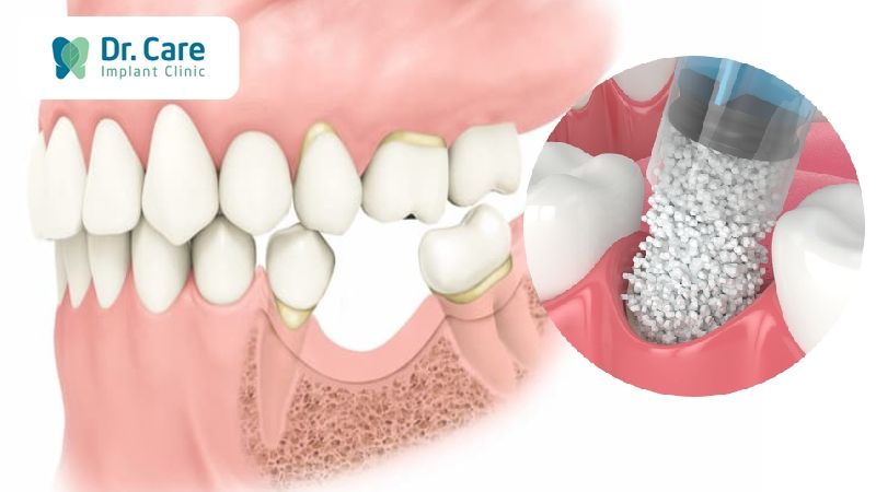 Quá trình trồng răng Implant có đau không nếu phải ghép xương?