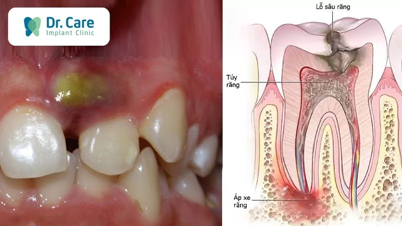 Các biến chứng khi bị sâu răng vào tủy