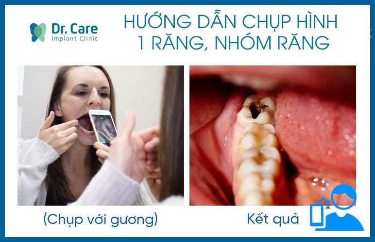 Chụp hình cận 1 răng hoặc nhóm răng