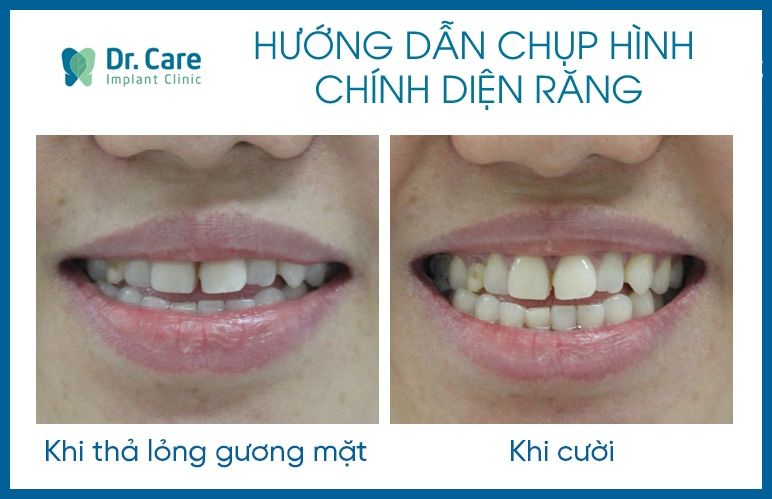 Chụp hình chính diện răng 