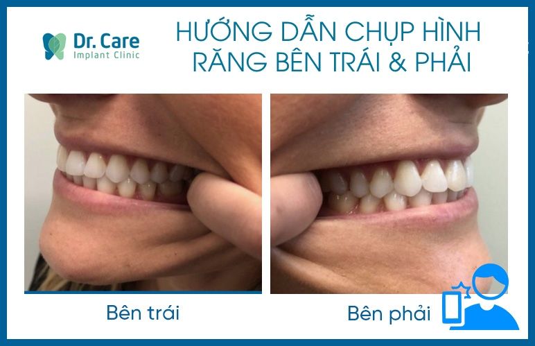 Chụp hình cận răng bên trái và bên phải