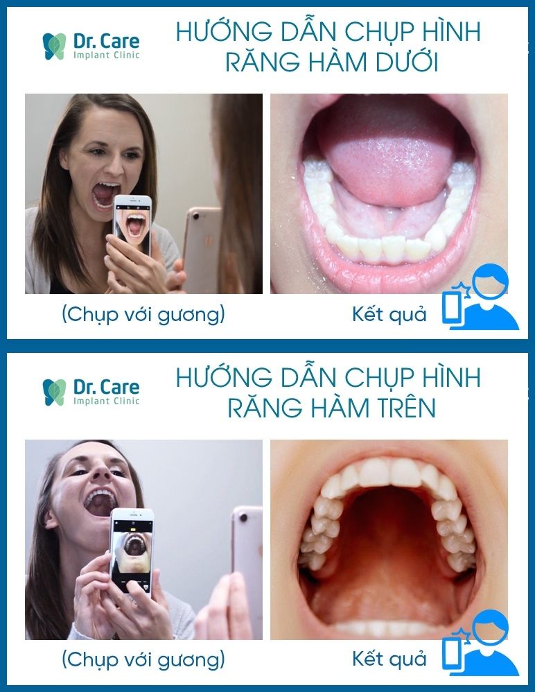 Chụp hình răng hàm trên và hàm dưới