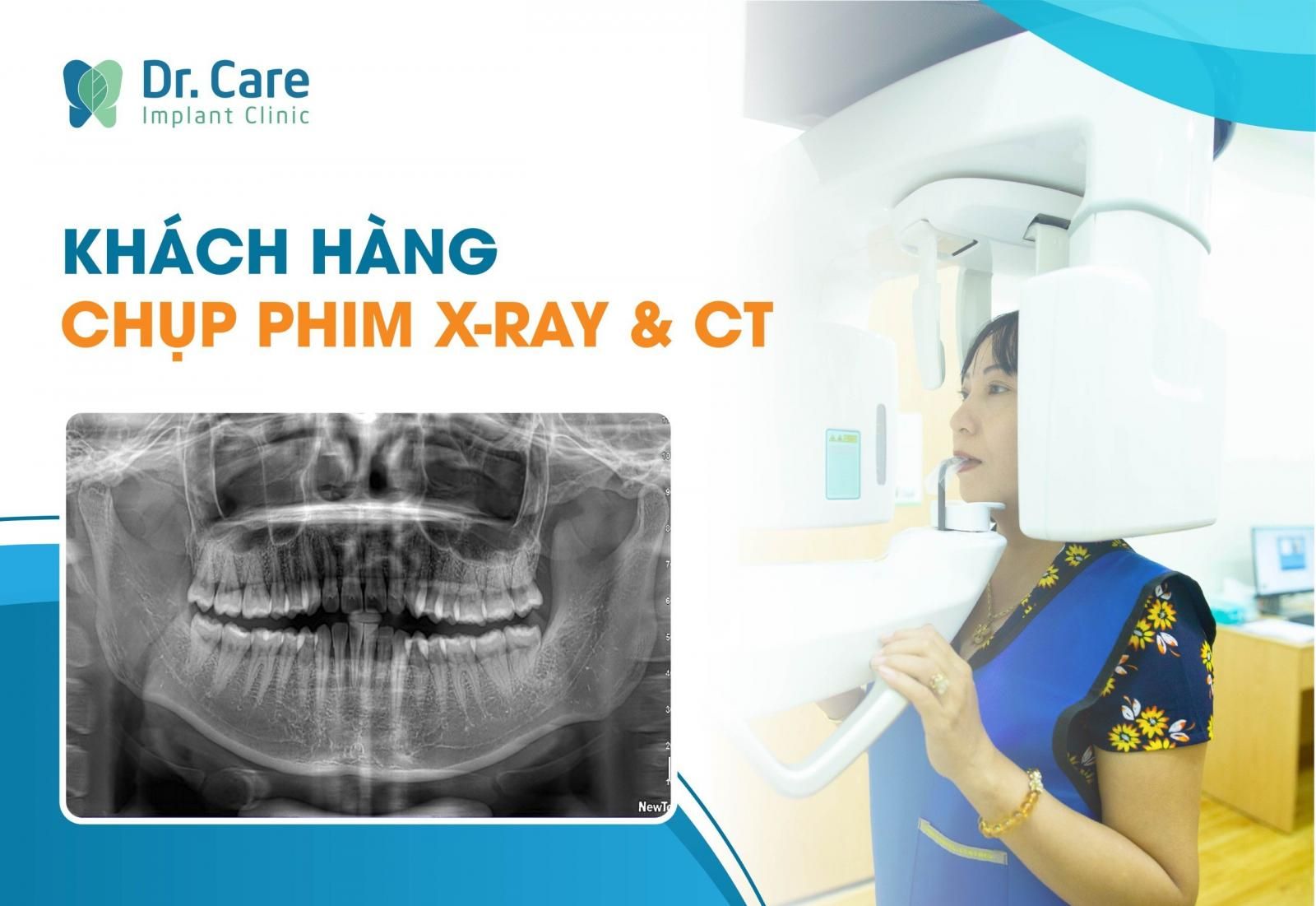 Chụp cắt lớp vi tính chùm tia hình nón (CBCT)