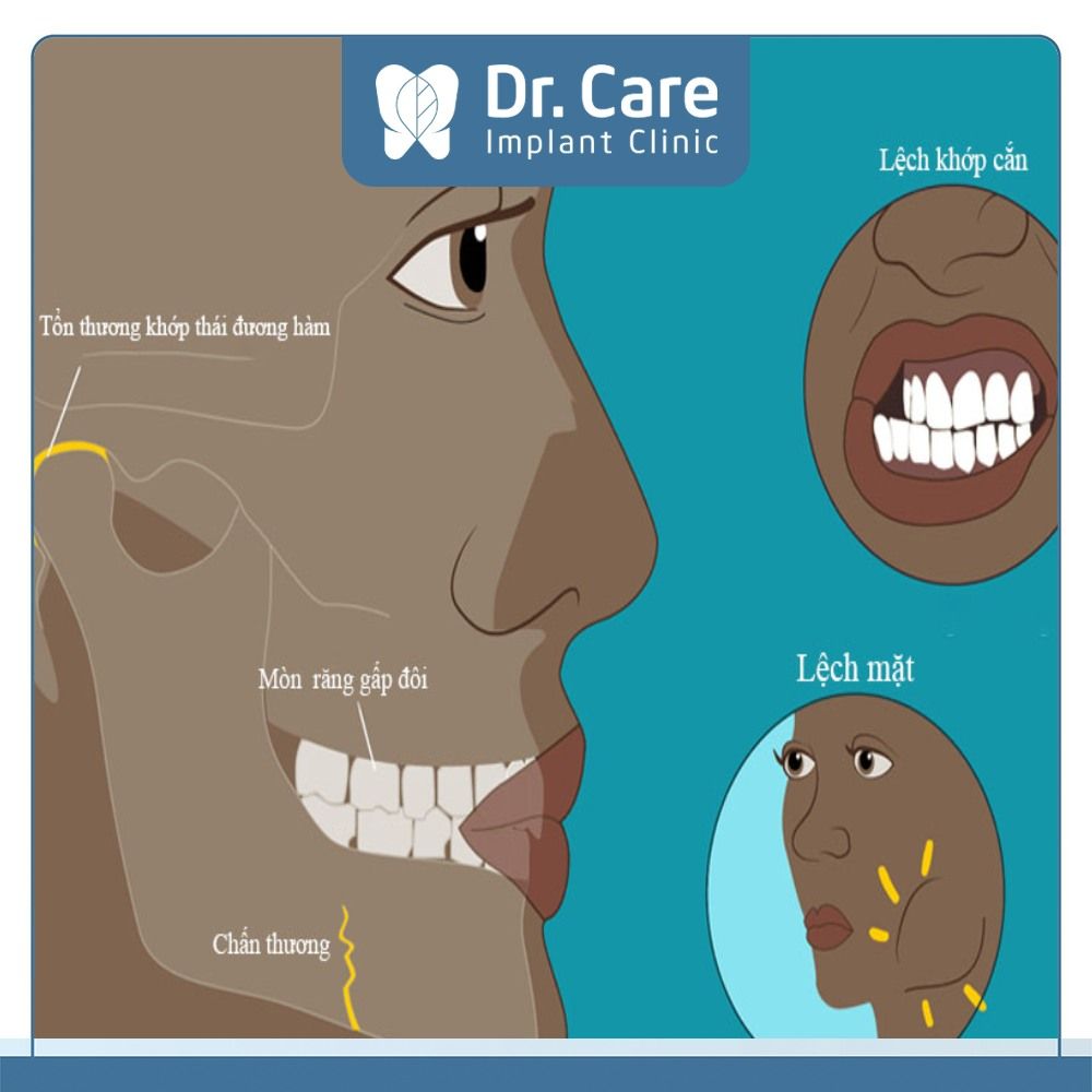 Mặt lệch bên trái do tai nạn