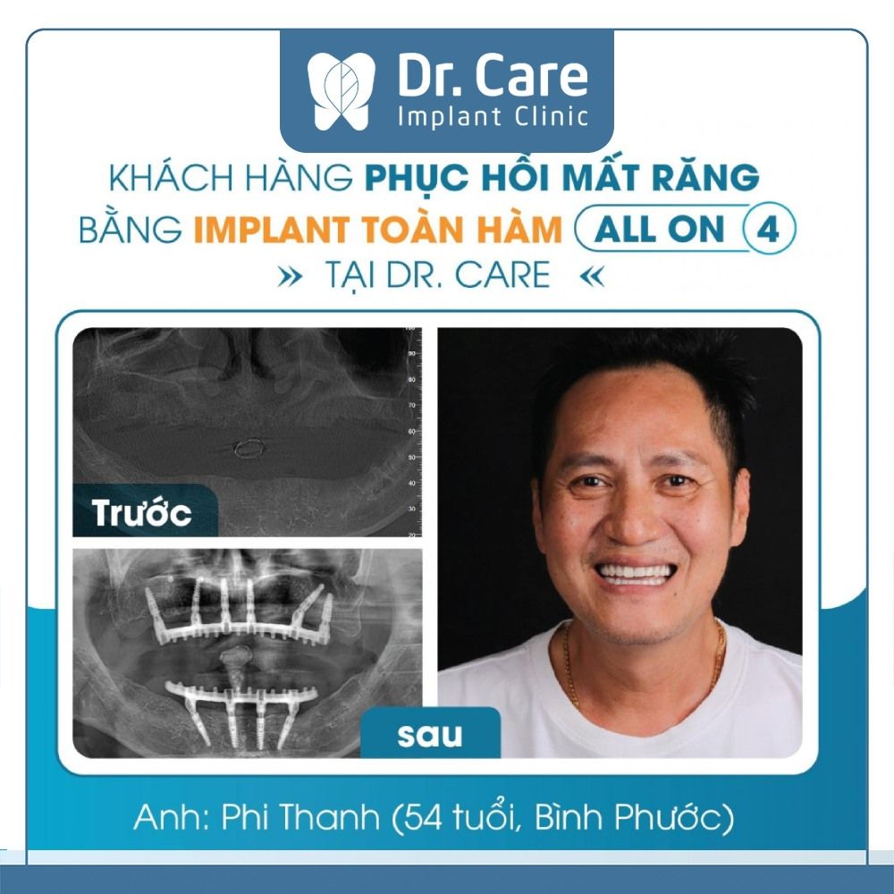 Đối tượng phù hợp trồng răng Implant 