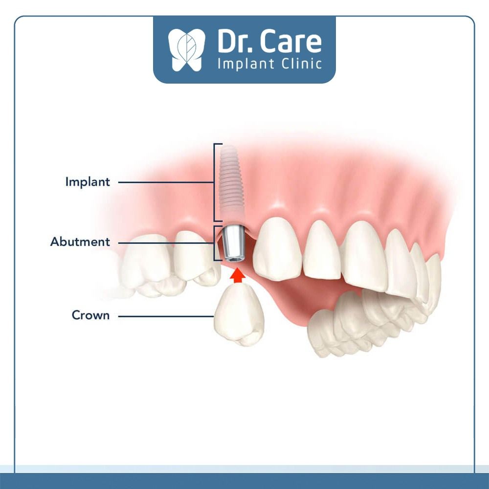 Cách khắc phục tình trạng thiếu mầm răng vĩnh viễn 