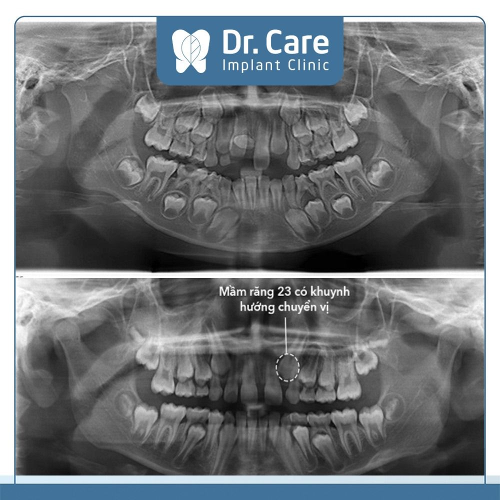 Mọc thiếu mầm răng vĩnh viễn ở trẻ gây ảnh hưởng gì? 