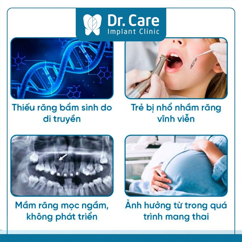 Nguyên nhân dẫn đến tình trạng mọc thiếu răng ở trẻ 