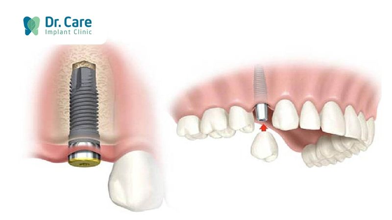 Mất răng do thói quen nghiến răng có khắc phục được không?