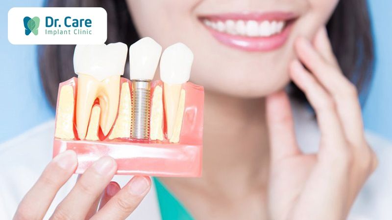 Tham khảo chi phí trồng răng Implant