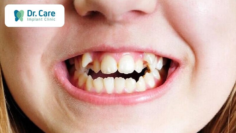 Những nguyên nhân khác dẫn đến việc nghiến răng khi ngủ