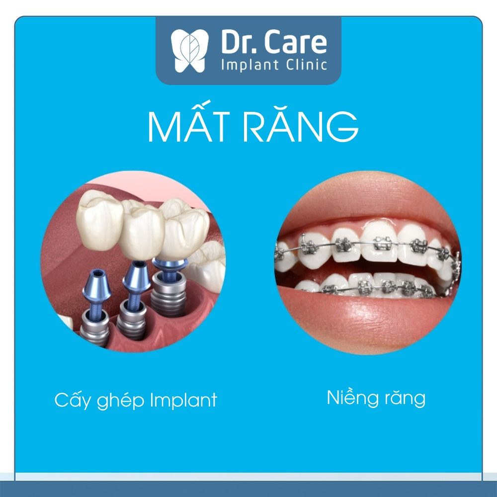 Mất răng nên niềng răng hay cấy ghép Implant?