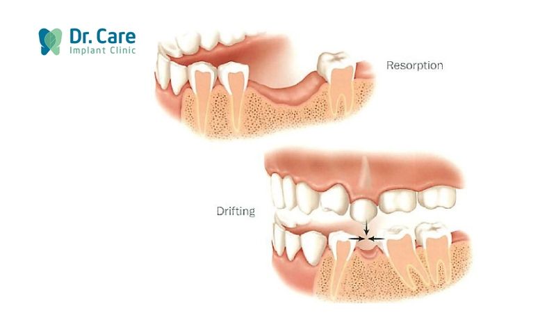 Vì sao mất răng khiến hàm bị xô lệch?