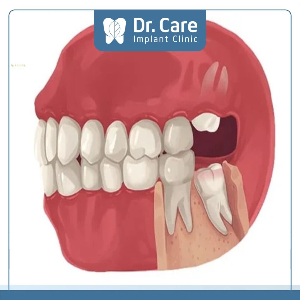 Quá trình mọc răng khôn diễn ra trong bao lâu?