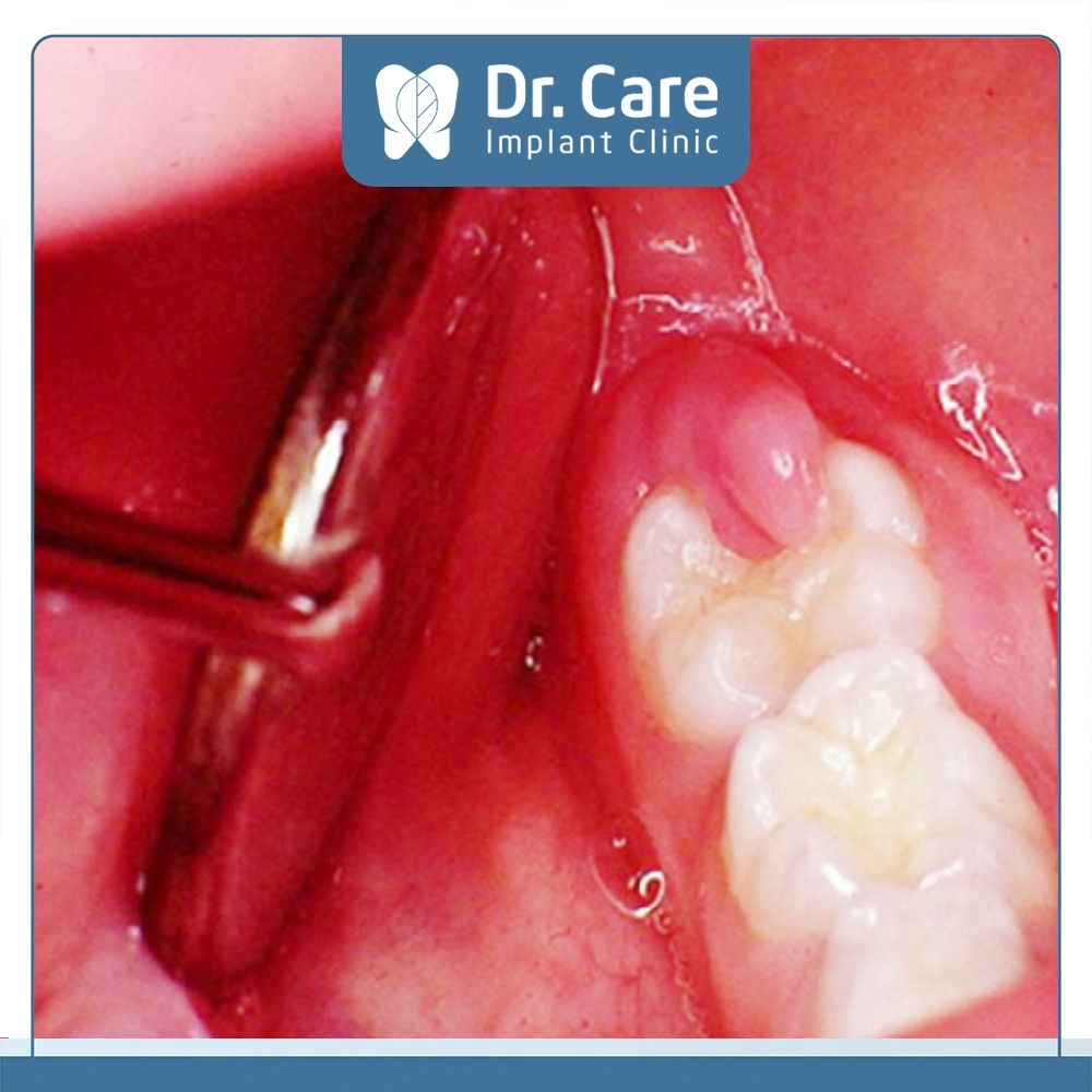 Những biến chứng có thể gặp khi mọc răng khôn