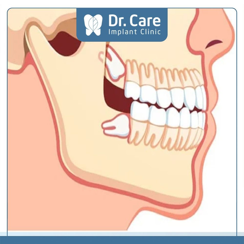 Độ tuổi nào sẽ mọc răng khôn?