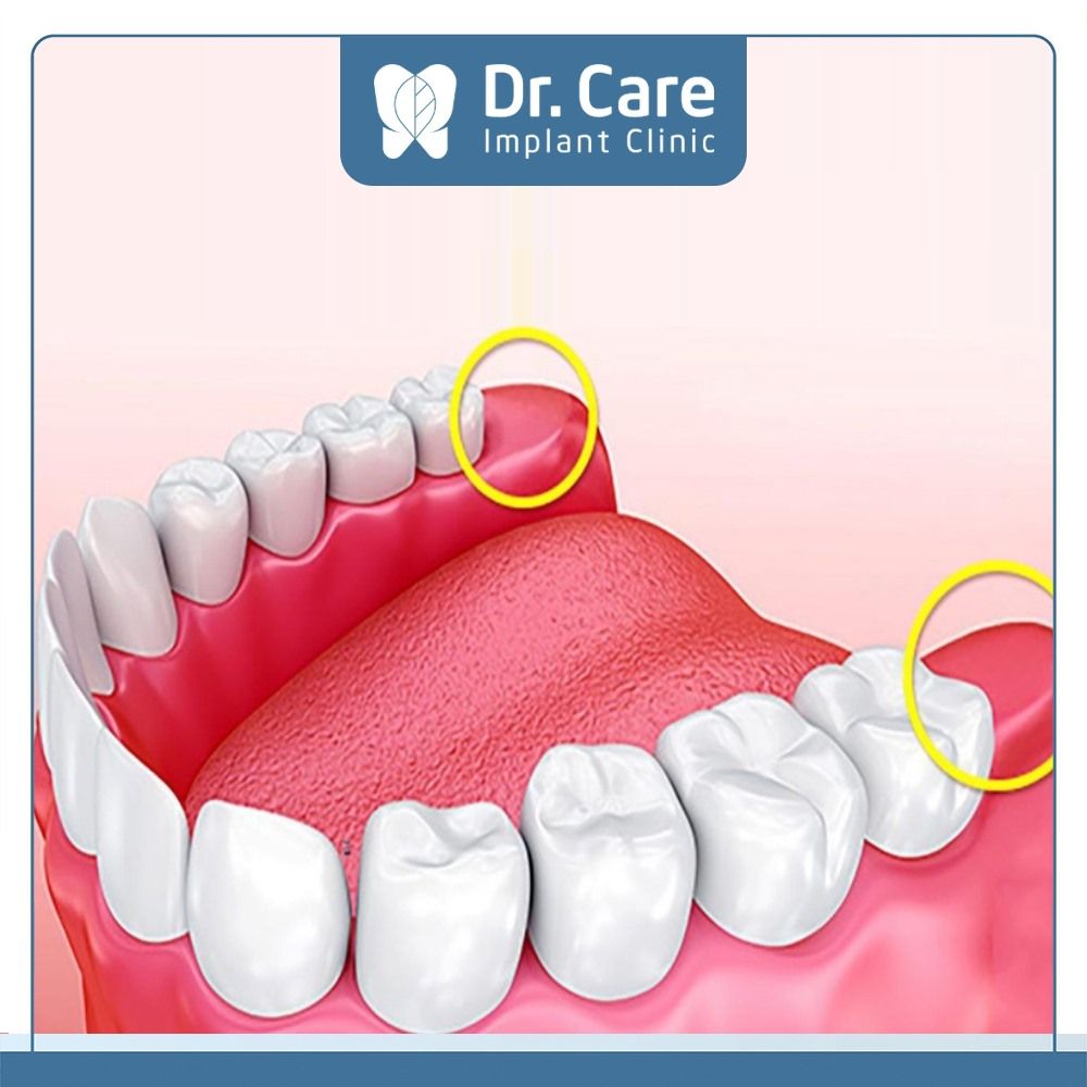 Không mọc răng khôn có bị sao không?