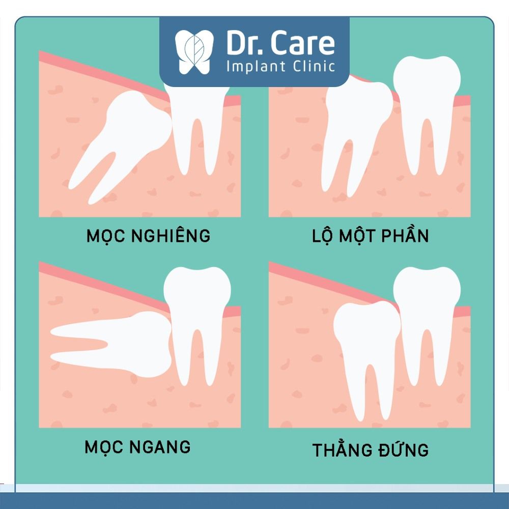 Một số tình trạng mọc răng khôn phổ biến