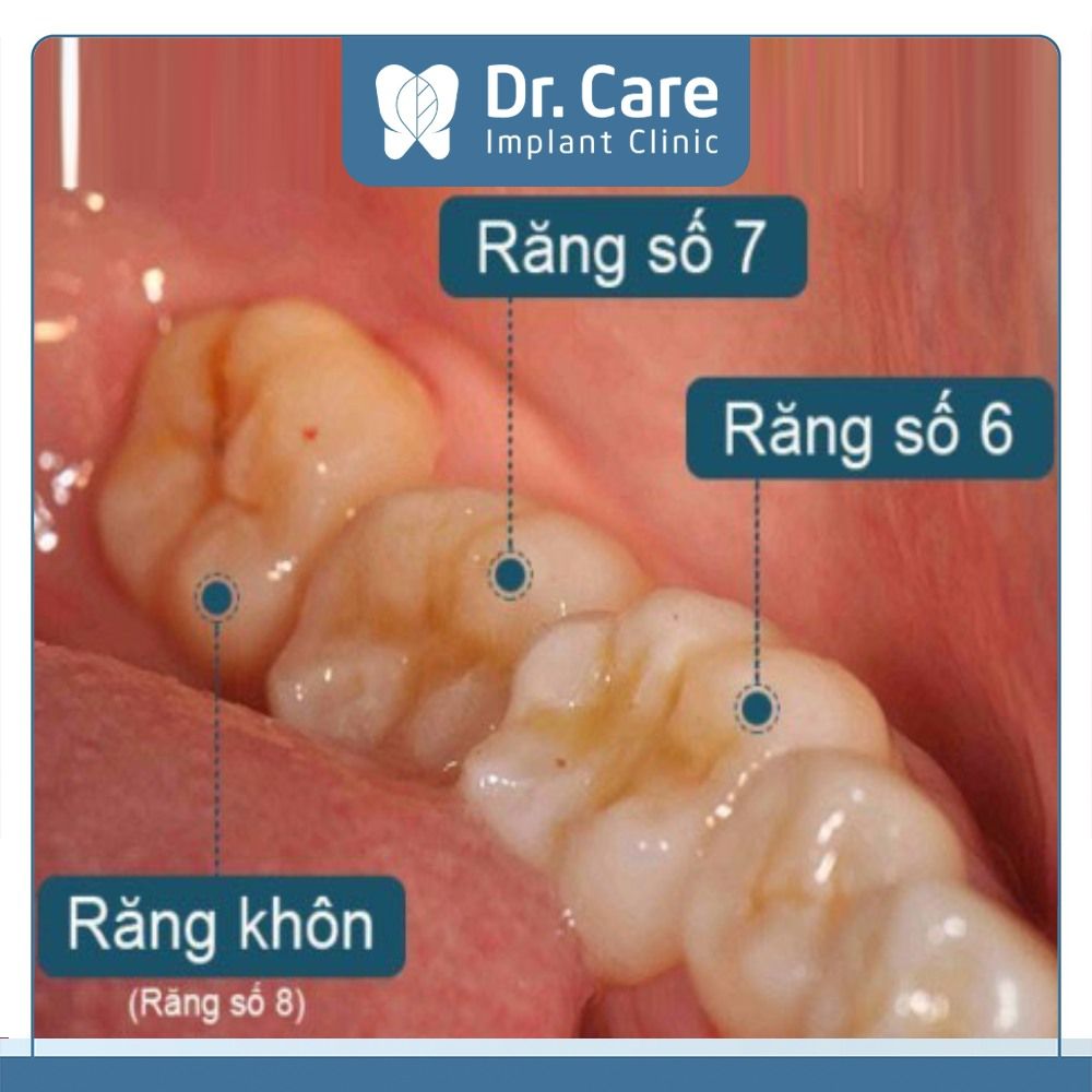 Những biến chứng có thể gặp khi mọc răng khôn