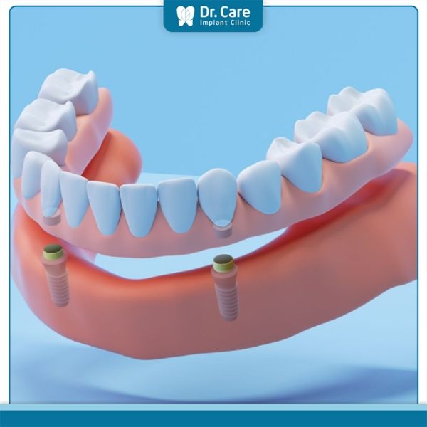 Ưu điểm hàm tháo lắp trên Implant