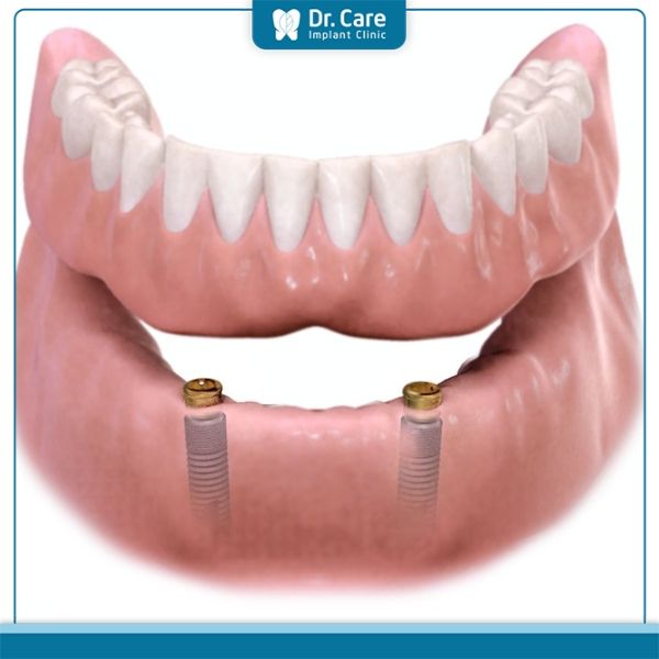 Có mấy loại hàm phủ trên Implant?