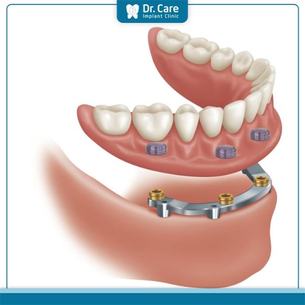 Có mấy loại hàm phủ trên Implant?