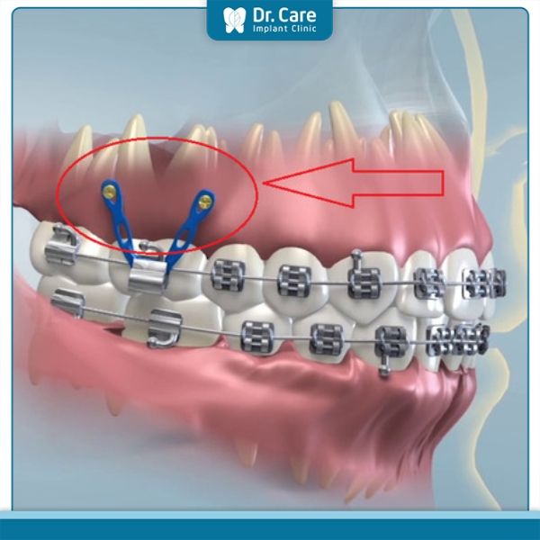 Tháo vít niềng răng có đau không?