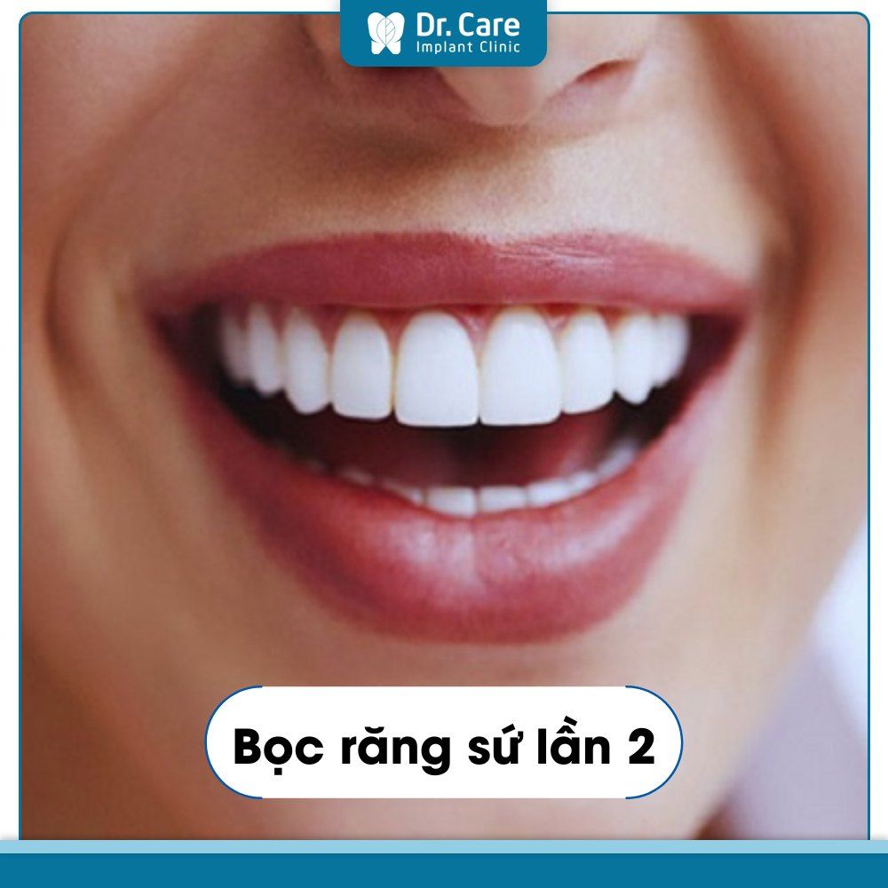 Bọc răng sứ bị tụt lợi nên bọc răng sứ lần 2 hay tìm giải pháp mới