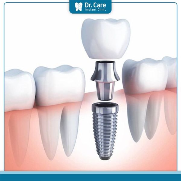 Cách lựa chọn răng sứ trên Implant phù hợp với cơ địa và tài chính