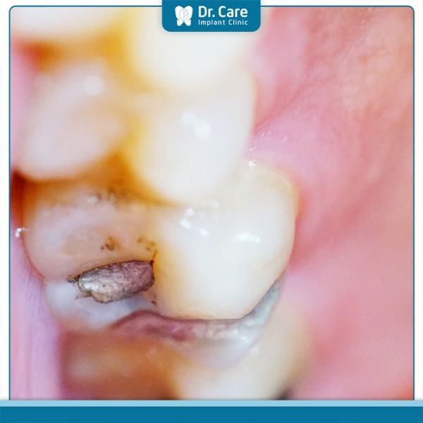 Trám răng bằng Amalgam hết bao nhiêu tiền?