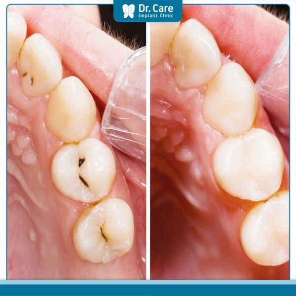 Giải pháp thay thế vật liệu trám răng Amalgam trong nha khoa