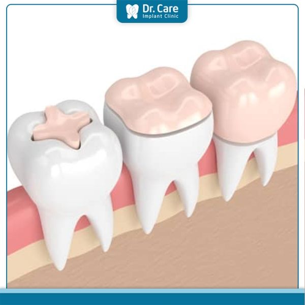 Quy trình các bước trám răng bằng composite