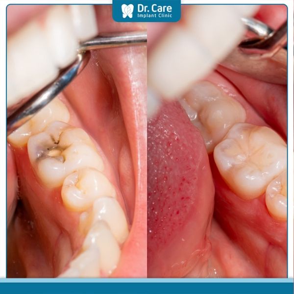 Đối tượng nào phù hợp trám răng thẩm mỹ composite?