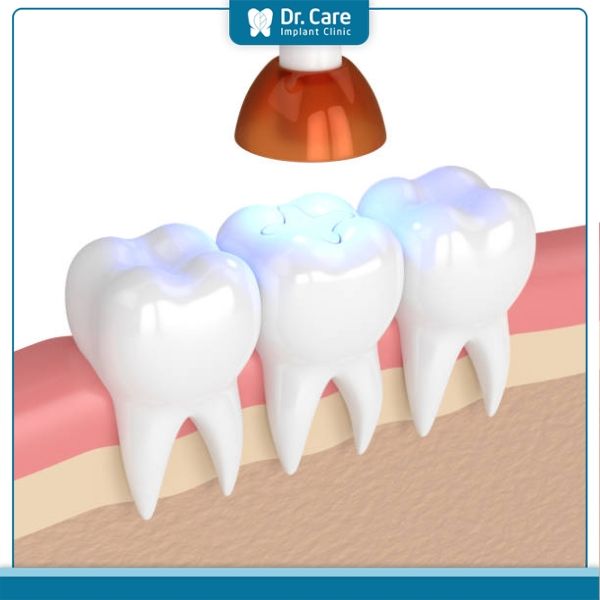 Ưu điểm của phương pháp trám răng thẩm mỹ bằng composite