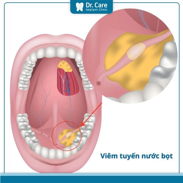 Viêm tuyến nước bọt là gì?