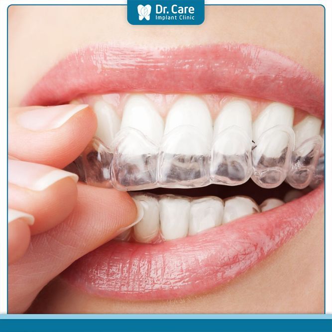 Niềng răng trong suốt invisalign là gì?