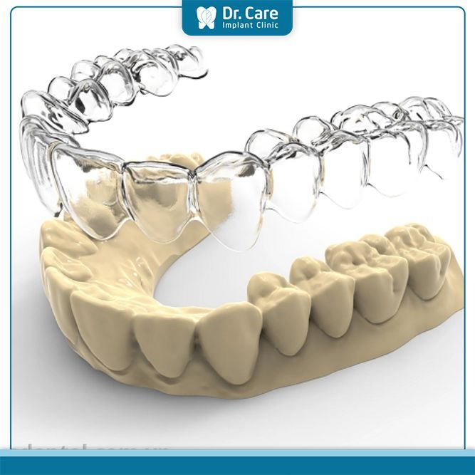 Niềng răng invisalign được chỉ định trong trường hợp nào?