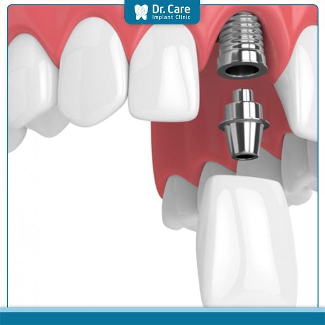 Giải pháp khắc phục tình trạng răng cửa thưa 