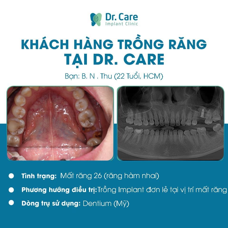 Dịch vụ trồng răng tại nha khoa Dr. Care